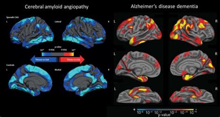 Cerebral Amyloid Angiopathy | Dementia Support Forum