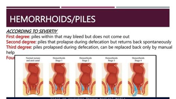 My Hemorrhoids Keep Coming Back; What Should I Do?